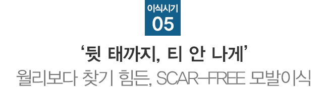 이식시기5. 뒷태까지 티안나게 월리보다 찾기 힘든 SCAR-FREE 모발이식